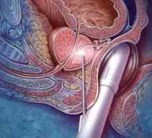 Uklanjanje prostate: posljedice operacije, recenzije