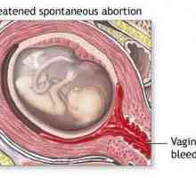 Prijetnja pobačaju: uzroci, simptomi i značajke liječenja