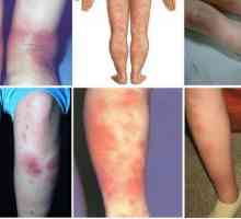 Nodularna eritema na nogama: simptomi, uzroci, liječenje