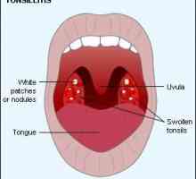 Vacuum pranje lacune of tonsils. Ispiranje lacune paladijskih tonzila