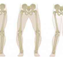 Valgusova deformacija zglobova koljena: fotografija, uzroci, liječenje