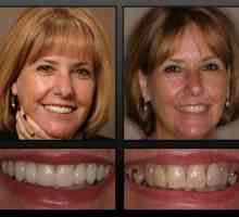 Povratak lijepog osmijeha pomoći će stalnim protetskim zubima
