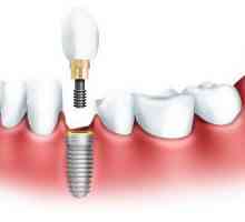 Vrste zubnih implantata: opis, prednosti i nedostatke, fotografija