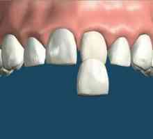 Vrata na zubima: prednosti elementa, svojstva instalacije i indikacije za uporabu