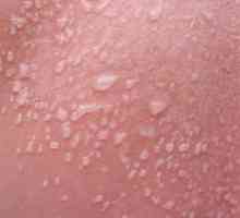Vodene akne na tijelu: mogući uzroci i karakteristike liječenja