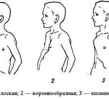 Lijevak oblikovan deformacija prsa: uzroci, simptomi, dijagnoza i liječenje