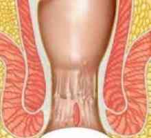 Upala anusa: uzroci, liječenje, prevencija, posljedice
