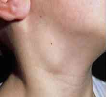 Lymphonoduses na vratu su upaljene. Što mogu učiniti kako bih olakšao stanje?