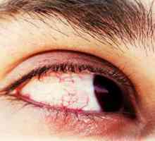 Izbijanja u očima: uzroci, simptomi