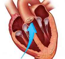 Zamjena aortalnog ventila: operacija, moguće komplikacije, recenzije