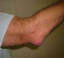 Tekućina u zglobu koljena: uzroci, simptomi i svojstva liječenja