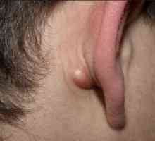 Zhirovik iza uha: mogući uzroci izgleda i osobitosti liječenja