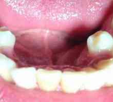 Zubni superkompleks: uzroci, simptomi i značajke liječenja