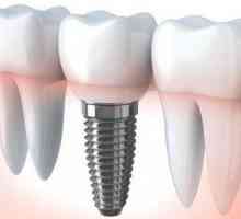 Zubna kruna za implantat: finoća instalacije