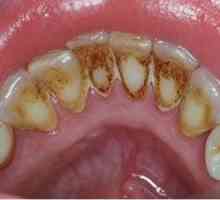 Zubni kamen - kako se riješiti? Zubne paste od tartara. Uklanjanje kamenca - recenzije