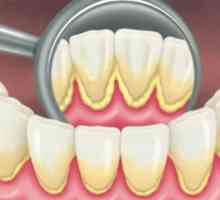 Naslage zuba: vrste, uzroci i metode zbrinjavanja