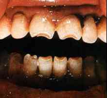 Getschinsonovi zubi: uzroci, opis oblika i strukture, fotografija