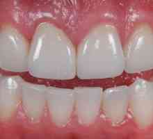 Keramičke zube: opis, značajke, proizvodnja i recenzije