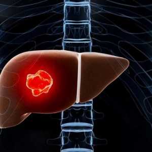 Adenoma jetre: uzroci, simptomi i karakteristike liječenja