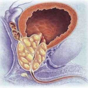 Što je adenoma prostate? Benigna hiperplazija prostate