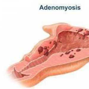 Adenomyoza uterusa - što je to? Adenomyoza maternice: liječenje s narodnim lijekovima, recenzije
