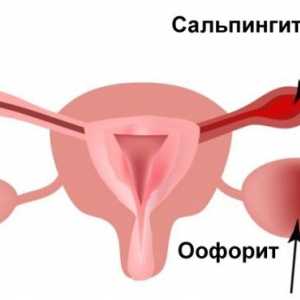 Adnexitis: simptomi i liječenje kod žena