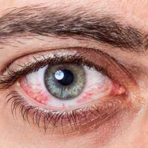 Alergijski na oči: kako liječiti, učinkovite načine i preporuke