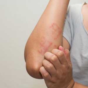 Alergije na kožu: mogući uzroci, simptomi i značajke liječenja