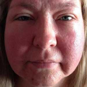 Alergija na lice na suncu: fotografije, simptomi, liječenje