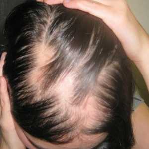 Alopecija je ono što je bolest? Uzroci, simptomi, liječenje alopecije