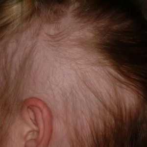 Alopecija u djece: uzroci i liječenje. Žarišna i ukupna alopecija kod djece