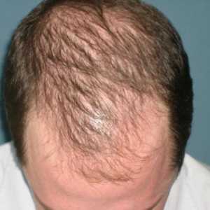 Ampule iz gubitka kose - koje su i kako se prijaviti