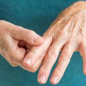 Analiza ACPC u reumatoidnom artritisu: norma, dekodiranje