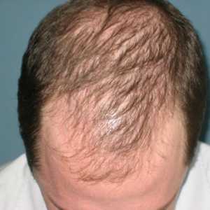 Androgena alopecija kod žena i muškaraca: uzroci, liječenje i posljedice