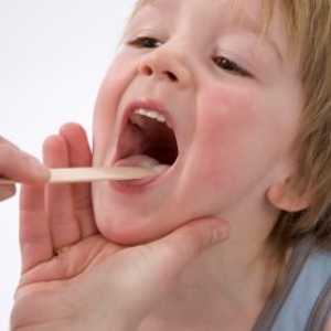 Angina u djece: što liječiti, koji su simptomi i uzroci bolesti