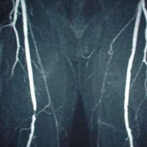 Angiografija posuda donjih ekstremiteta: kako se to izvodi?