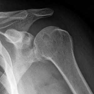 Artritis zgloba ramena: simptomi i liječenje