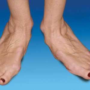 Artritis nogu: liječenje i uzroci izgleda