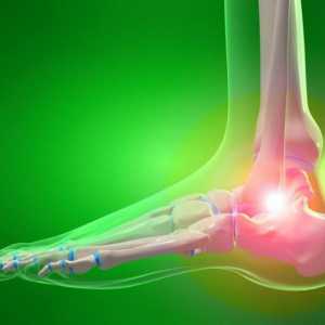 Osteoartritis gležnja: simptomi i liječenje. Uzroci i prevencija artroze gležnja