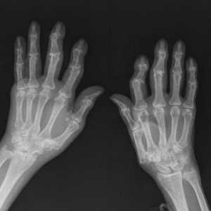 Artroza ruku: liječenje, simptomi i uzroci