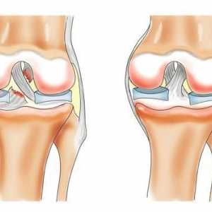 Osteoartritis koljena: liječenje kod kuće. Liječenje artroze folikularnih lijekova koljena