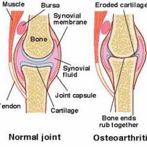 Artroza zgloba koljena: liječenje lijekovima i narodnih lijekova