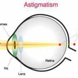 Astigmatske kontaktne leće: značajke, vrste i tehnologija korištenja