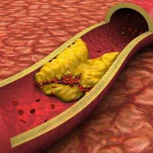 Aterosklerotična kardioskleroza: komplikacije. Kardioloskleroza: liječenje, simptomi, uzroci