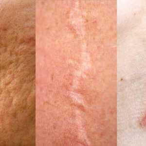 Atrofični ožiljci: uzroci pojavljivanja, liječenja