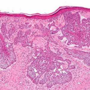 Rak debelog crijeva: Simptomi, dijagnoza, liječenje