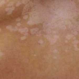 Bijele točke na koži nakon opeklina: liječenje, fotografija