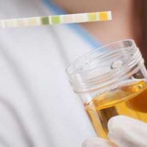 Biokemija urina: pravila prikupljanja i pokazatelji norme
