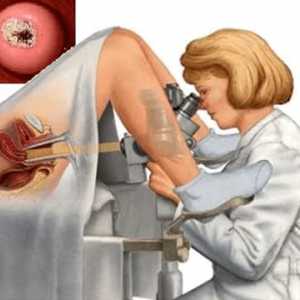 Biopsija cerviksa: što je to i zašto se taj postupak izvodi?