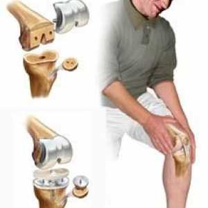 Bol u koljenima kada se čuče i ustaje. Liječenje s narodnim lijekovima